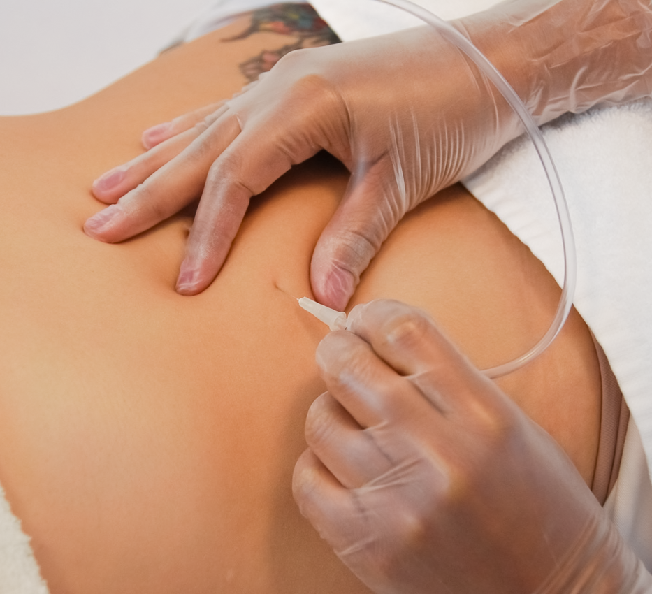 carboxiterapia-moldeo-corporal Carboxiterapia