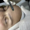 dermaplanning
