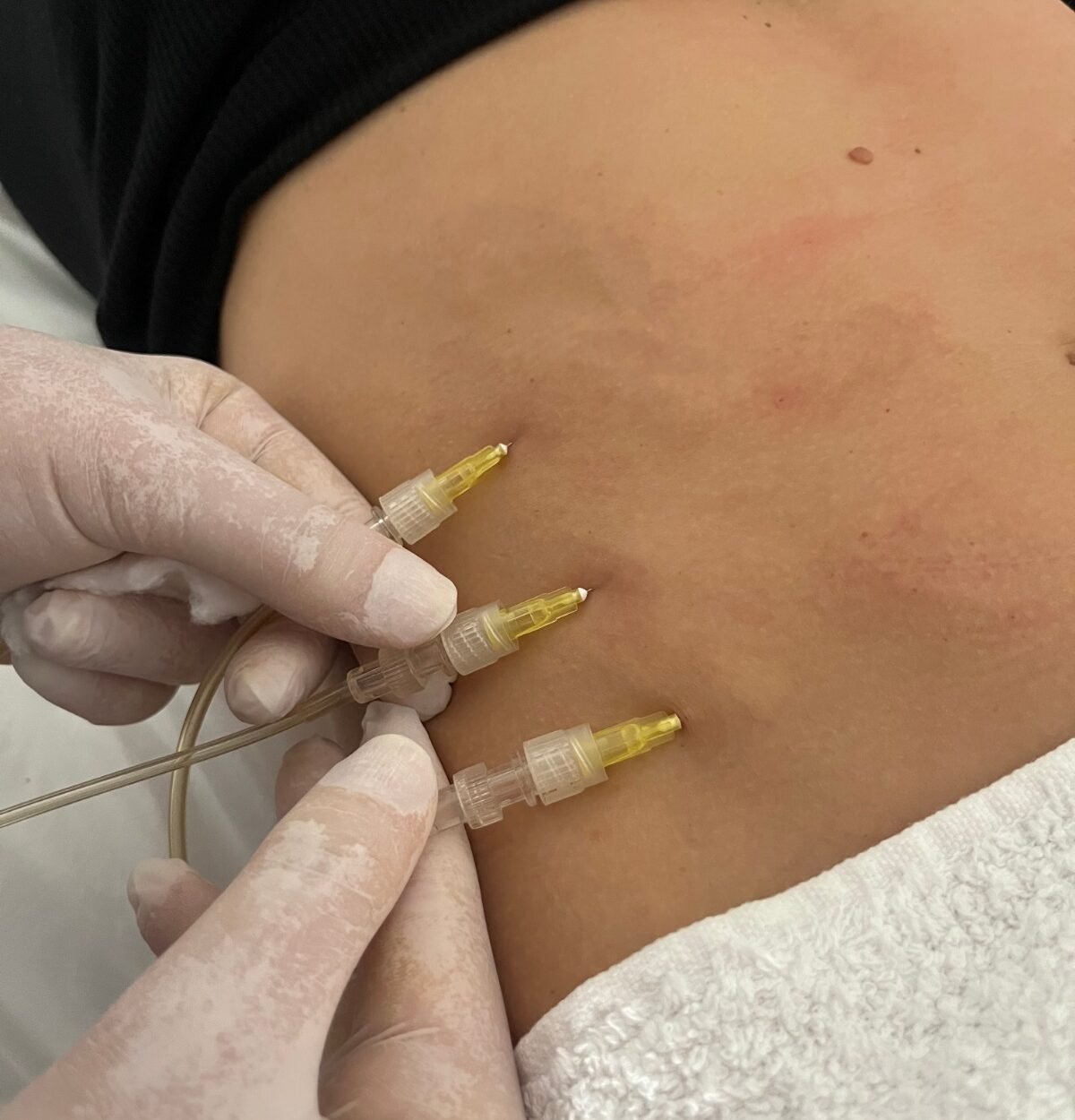carboxi1 Abdomen con aplicación de carboxiterapia