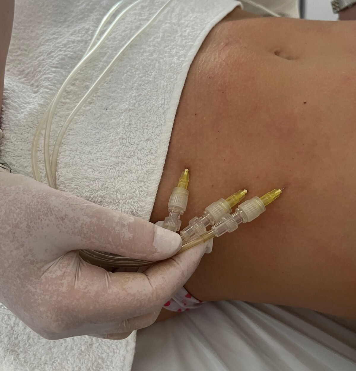 carboxi2 Abdomen con aplicacion de carboxiterapia